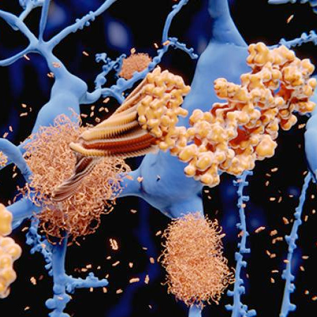 Amyloid beta plaque