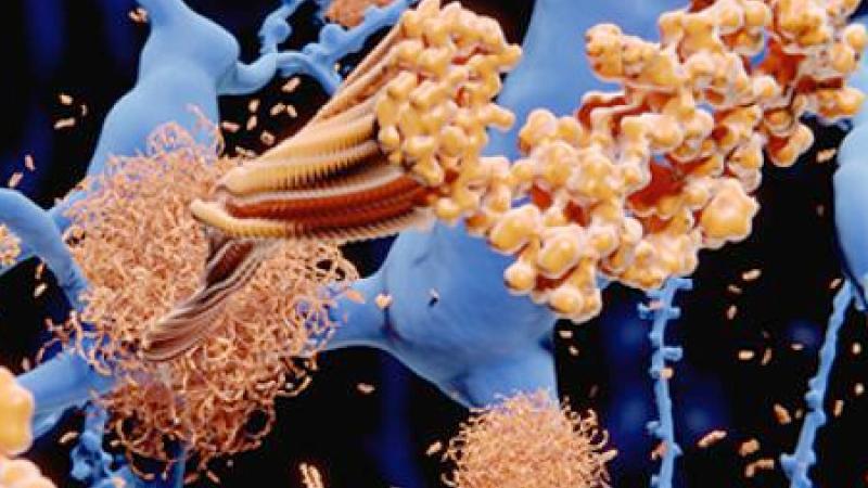 Amyloid beta plaque